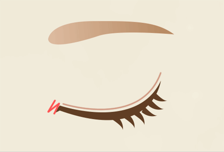 目頭切開（Z形切開法）